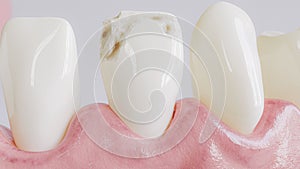 Tooth with caries attack in closeup - 3D Rendering