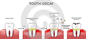 Tooth caries and cavity