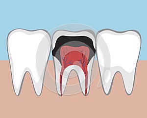Tooth with caries, Flat vector stock illustration with Molar of an adult with pulpitis