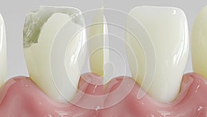 Tooth after caries treatment as closeup- 3D rendering