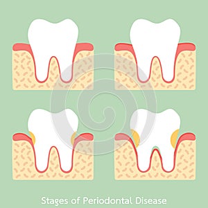 Step of periodontal disease / periodontitis / gingivitis / gum disease, dental problem photo
