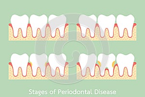 Step of periodontal disease / periodontitis / gingivitis / gum disease, dental problem photo