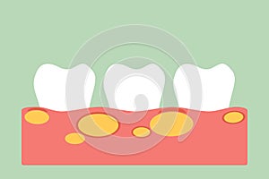 Unhealthy teeth because gingivitis with abscess in gum and dental plaque or tartar photo