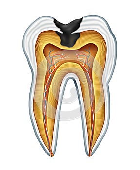 Tooth cavity photo