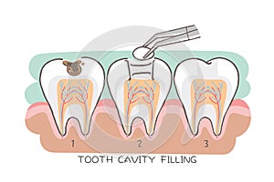 Tooth cavity filling photo