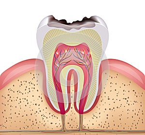 Tooth cross section with dental caries