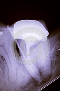 Tooth crown root canal