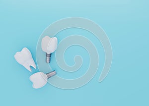 Tooth Crown and Tooth Implants