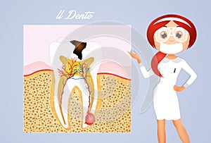 The tooth decay