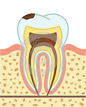 Tooth decay