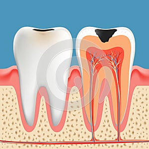 Tooth decay anatomy poster.  Enamel and dentin caries