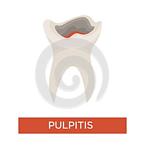 Tooth decay caries stage dentistry and dental health pulpitis