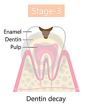 Tooth decay symptom, dentin cavity. Dental and oral health care concept. photo