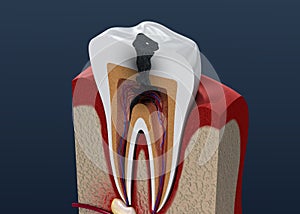 Tooth decay. illustration photo
