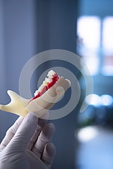 Tooth decay dental model