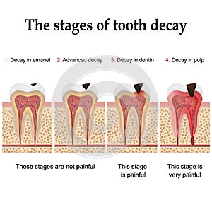 Tooth decay formation