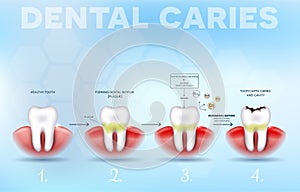 Tooth decay formation poster