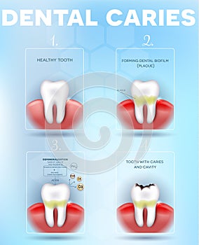 Tooth decay formation poster