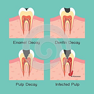 Tooth decay photo