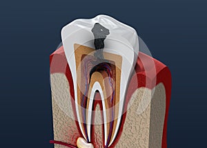 Tooth decay. illustration