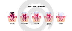 Tooth decay and root canal treatment chart. Vector biomedical illustration. Cross section. Teeth in gum feeling steps isolated on