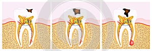 Tooth decay scheme photo