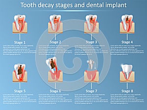 Tooth decay stages and dental implant vector illustration