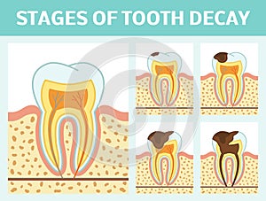 Tooth decay stages photo