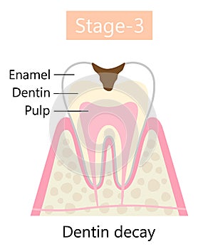 Tooth decay symptom, dentin cavity. Dental and oral health care concept.