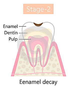 Tooth decay symptom, Enamel decay results in dental cavity formation. Dental and oral care health concept