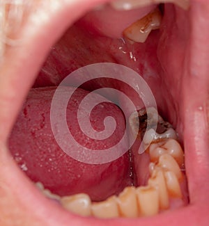Tooth decay photo
