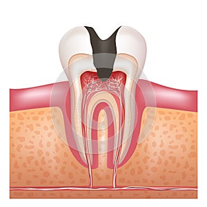 A tooth with deep caries. Pulpitis. Vector illustration