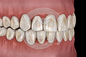 Tooth demineralization, removal of minerals from hard tissues: enamel, dentine, and cementu. Medically accurate 3D illustration photo