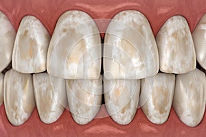 Tooth demineralization, removal of minerals from hard tissues: enamel, dentine, and cementu. Medically accurate 3D illustration photo