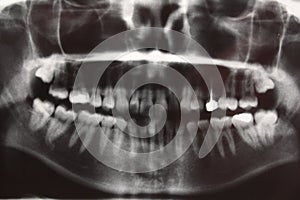 Tooth dental dentist radiograpy anatomy