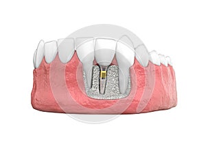 Tooth dental implant model 3d illustration