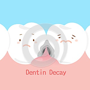 Tooth with dentin decay