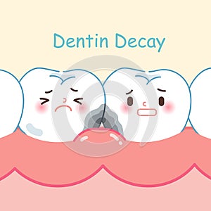 Tooth with dentin decay photo