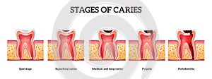 Tooth Destruction Stages