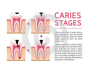 Tooth on different stages of dental caries development.
