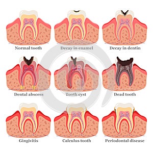 Tooth disorders set, flat vector illustration. Healthy and unhealthy teeth. Dental problems and diseases.