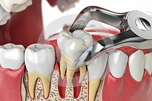 Tooth extraction by dental forceps on model of human jaw.