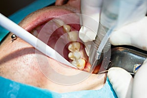 Tooth extraction without using forceps