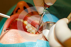 Tooth extraction without using forceps photo