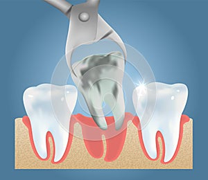 Tooth extraction vector medical poster design template