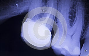 Tooth filling dental xray