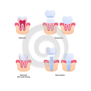 Tooth filling and implant chart. Vector biomedical illustration. Cross section. Filled teeth and prosthesis implantation steps