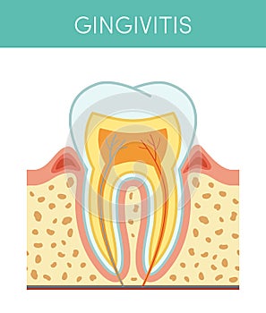 Tooth with gingivitis