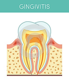 Tooth with gingivitis photo