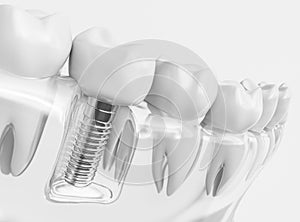 Tooth human implant - 3D Rendering